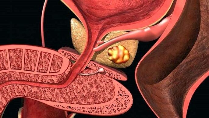 Prostate stone deposition accompanied by calculus prostatitis