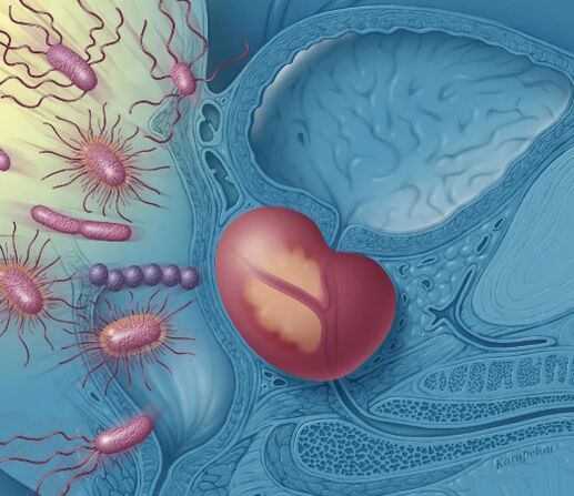 prostate inflammation