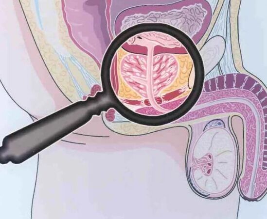 prostatitis